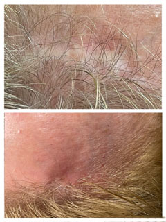 Hairline scar camouflage with medical tattooing