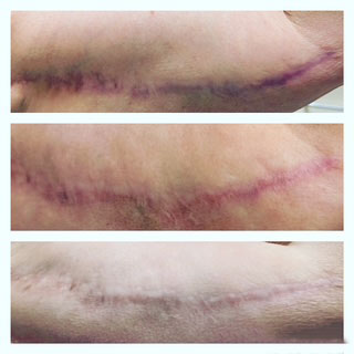 Scar camouflage before and after paramedical tattooing