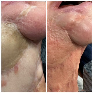 Neck scar camouflage before and after treatment