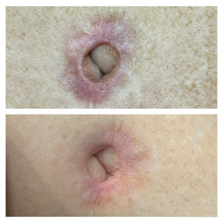 Umbilical scar restoration with paramedical tattooing