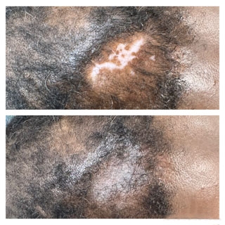 Scalp scar camouflage before and after treatment