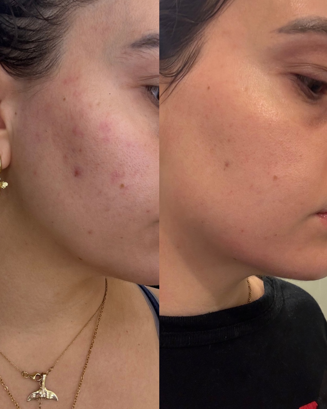 Skin clarity before and after