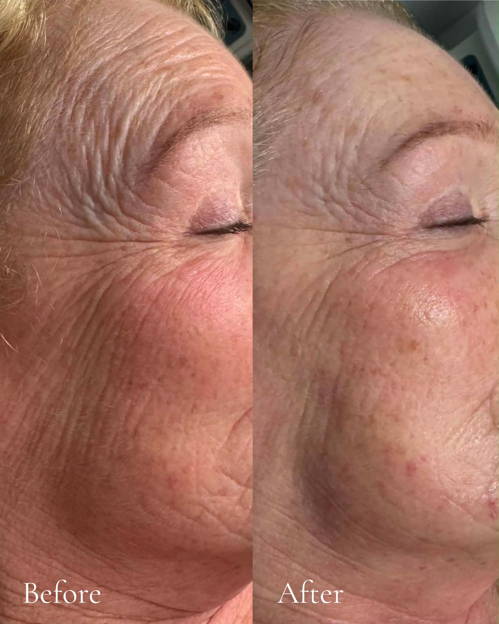 Eye area skin before and after