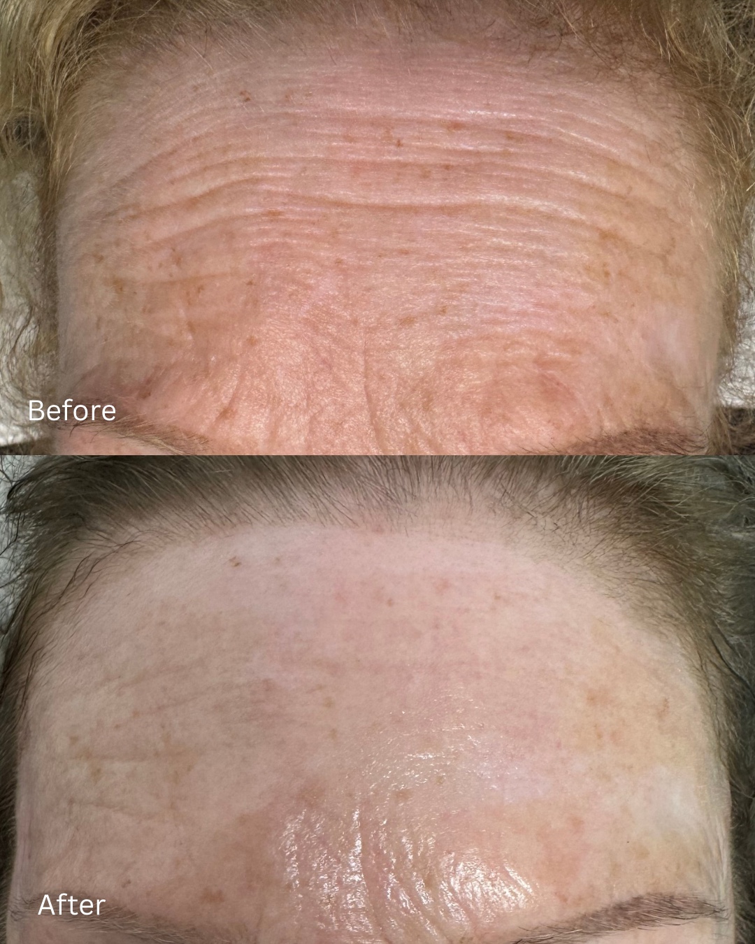 Forehead skin before and after