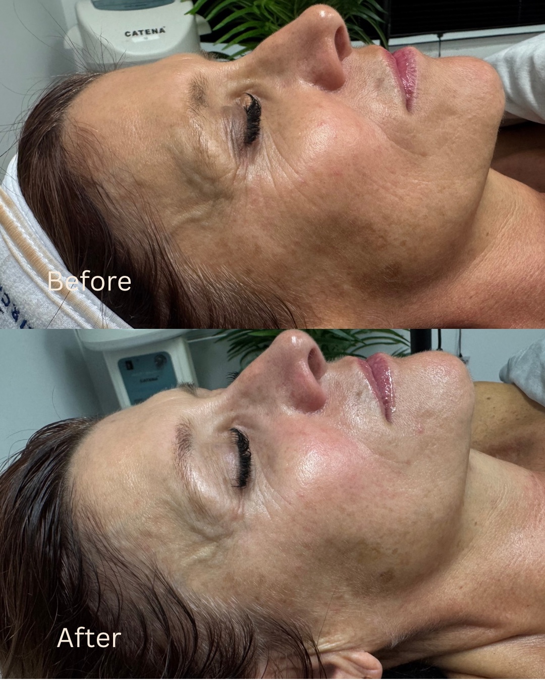 Skin treatment before and after