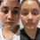 Thumbnail: HALE acne transformation system