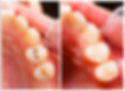 como sanar una caries dental
