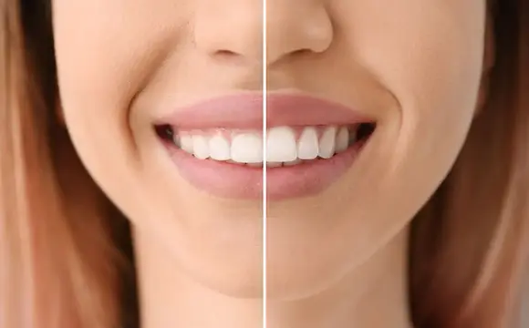 gingivectomia-clinica-dental-periodontium-01.webp