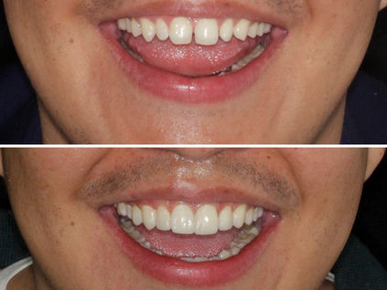 Carillas de Resina: La Solución Rápida y Efectiva para una Sonrisa Perfecta