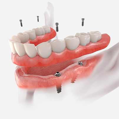 tratamientos-protesis-dentales-con-la-ultima-tecnologia.jpeg