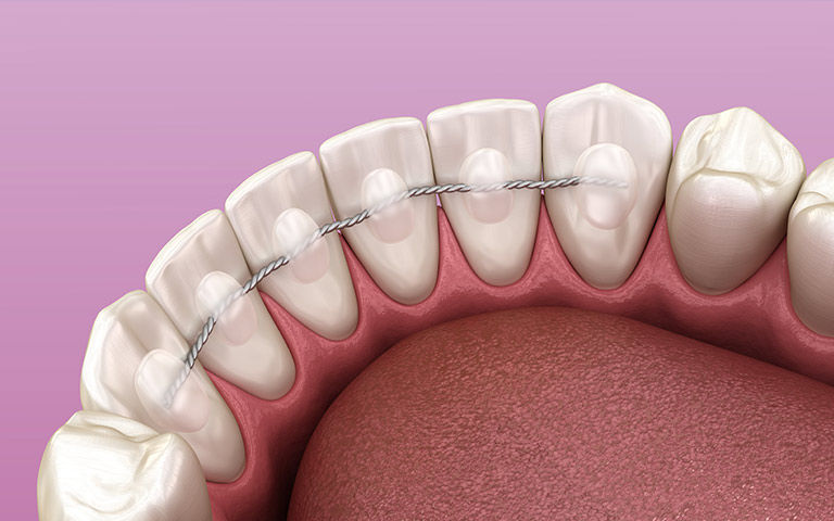 tipos de retenedores dentales