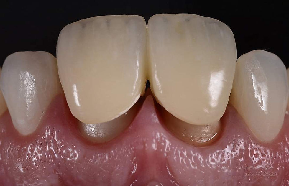¿Cuándo es el momento de reemplazar una corona dental? Señales que no deberías ignorar
