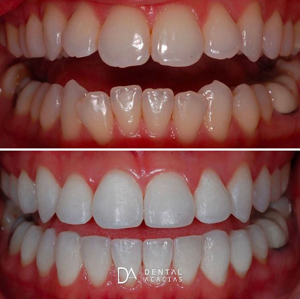 antes y después de blanqueamiento dental