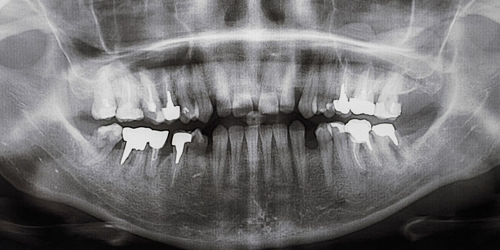 importancia del hueso en los implantes dentales