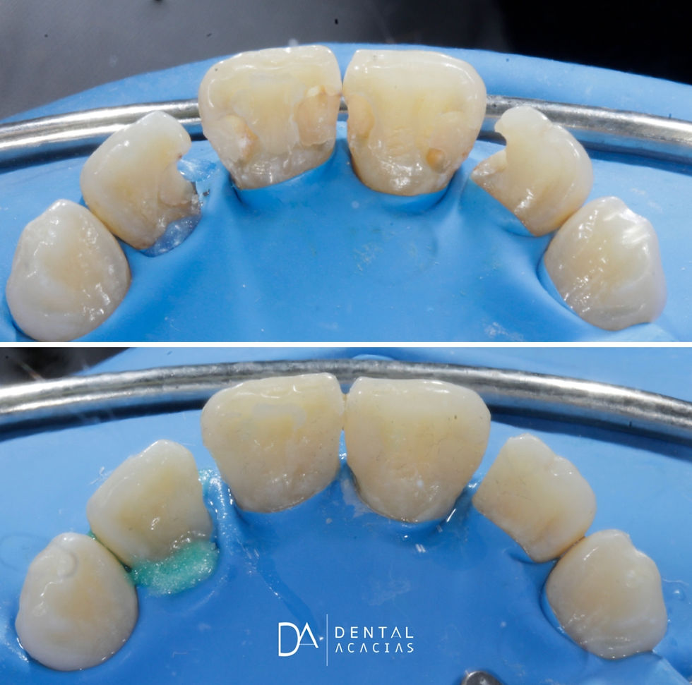 importancia del aislamiento absoluto en odontologia