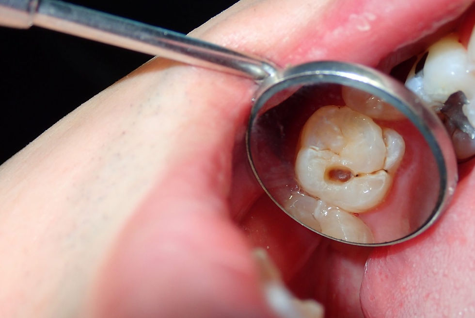 ¿Cómo saber si tengo una caries? Señales que no debes ignorar