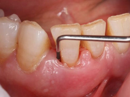 Cómo la diabetes puede afectar tus encÃas (y viceversa)