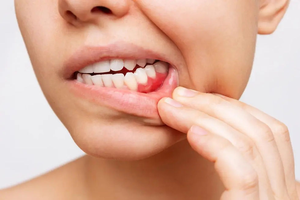 gingivitis, qué es y como combatirla