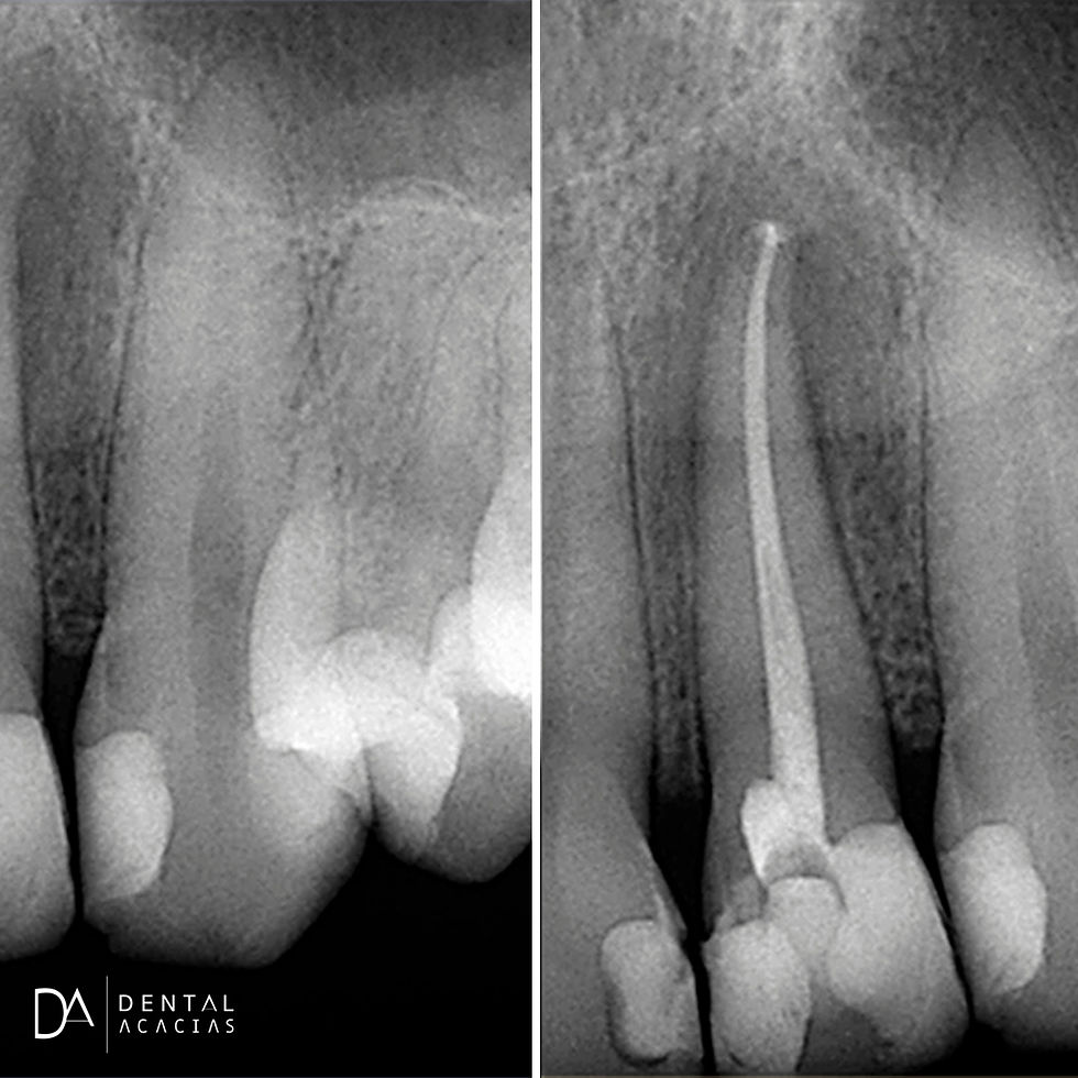 Endodoncia Dental Acacias