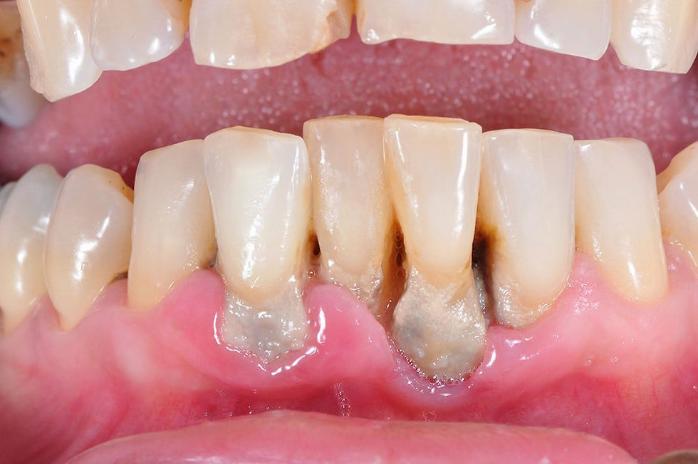 la periodontitis se contagia