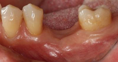 pérdida de hueso en odontologia