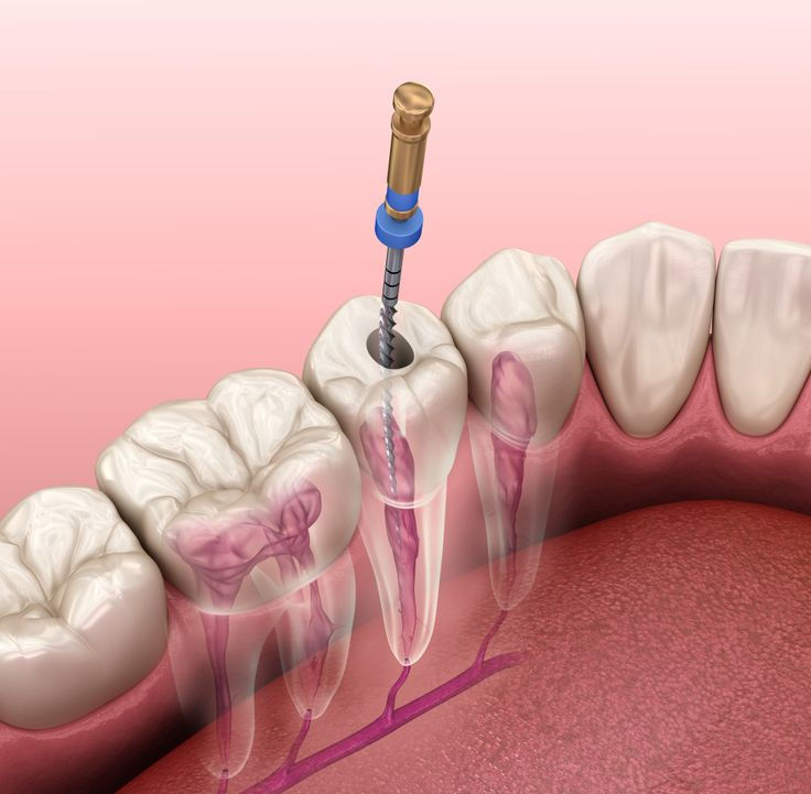 Cómo se realiza una endodoncia