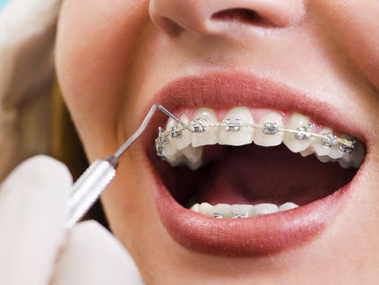 Brackets autoligables vs convencionales: diferencias reales más allá de la estética