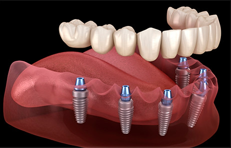 arcada-completa-sobre-implantes.jpeg