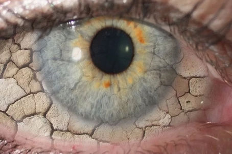 An Eye-Opening Guide to Dry Eye Disease