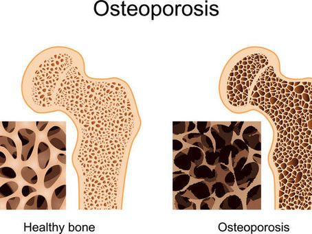 Minerals Associated with Greater Bone Density