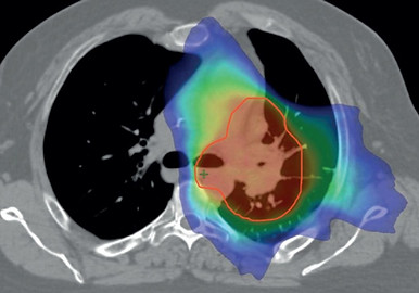 AARO Targeted Radiotherapy
