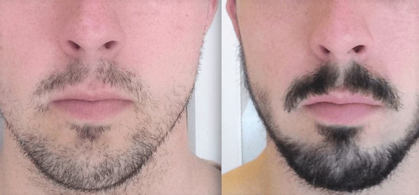 Thumbnail: Natural Beard Growth Serum. (Order From Our eBay or  Etsy Shop)