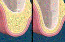 sinus_lift.gif