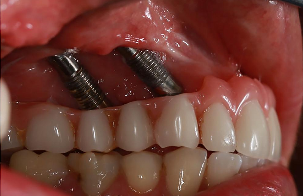Figure 2. Intraoral exposure of zygomatic implants in semi-profile, highlighting the level of peri-implantitis, despite all hygiene measures having been strictly followed.
