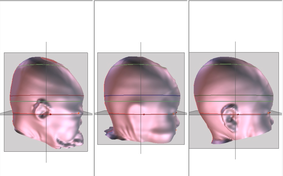 Research Spotlight "Helmets Work For Brachycephaly"