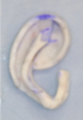 肋軟骨移植2.png