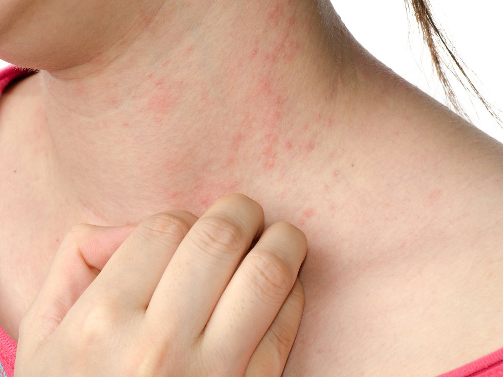 CBD for Eczema