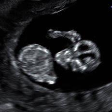 fetal ultrasound