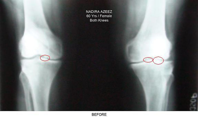 Knee arthritis before Curatron PEMF therapy