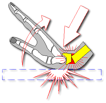 collesova-fraktura-zlomenina-predlokti-zapesti-priznaky-projevy-symptomy.gif