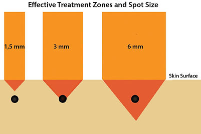 Effective Treatment Zones and Spot Size