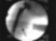 CT image that demonstrates unobstructed visualization