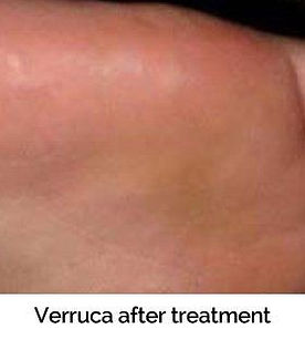 Verruca after treatment