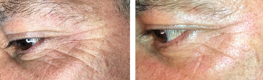 Example of Lip Hair Removal