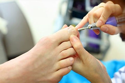 YAG hot laser treatment
