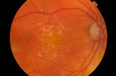 Dry amd