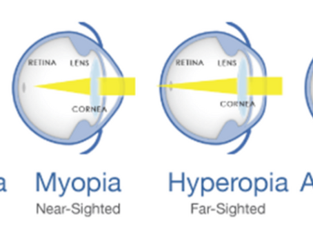 REFRACTIVE EYE SURGERY