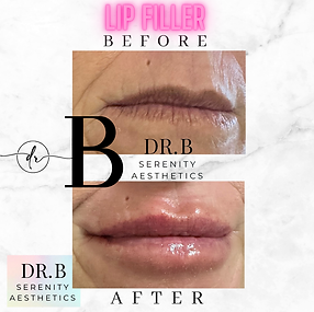 Lip Filler for Mature Lips