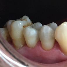 Diente con tapadura de resina estética blanca.