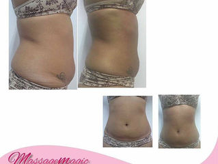 Boa Noite...hoje vim falar sobre a Massage Magic, é uma técnica que visa reduzir gorduras localizada